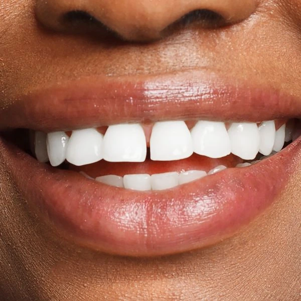 Whiter teeth in 1 hour with Blue light teeth whitening Aylesbury! 