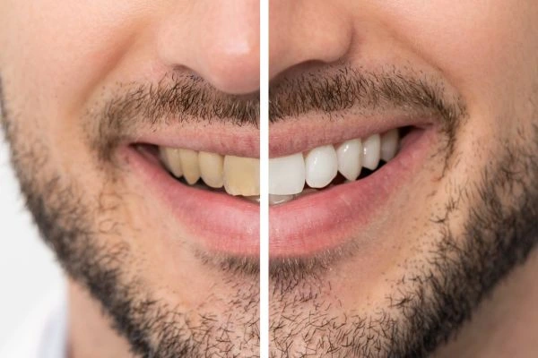 A whiter smile in just 1 hour with Blue light teeth whitening Hertfordshire! 