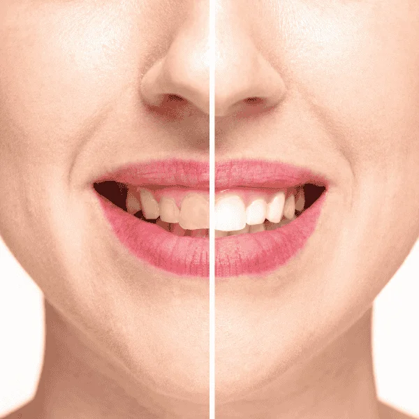 Looking for Blue light teeth whitening Aylesbury? Book in today! 