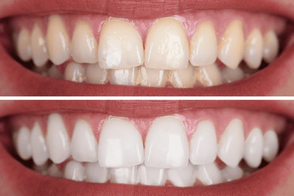 Fast teeth whitening Worthing - whiter teeth in just an hour! 