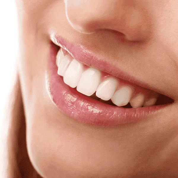 Looking for fast teeth whitening Luton? Contact LA Teeth Whitening Today! 