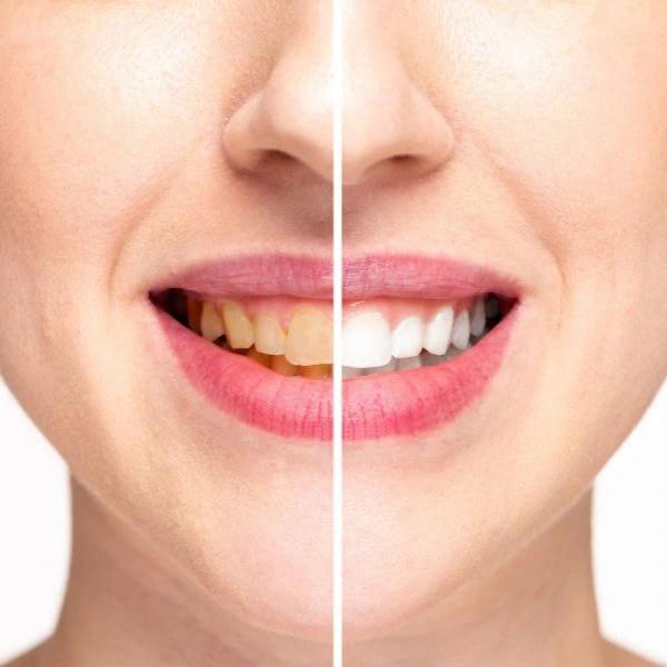 Book in for LED Light Teeth Whitening Cambridge today! 