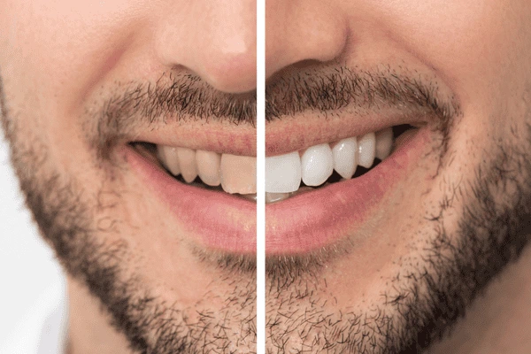 Do you want whiter teeth in just 1 hour? Book your zoom teeth whitening Buckinghamshire today! 