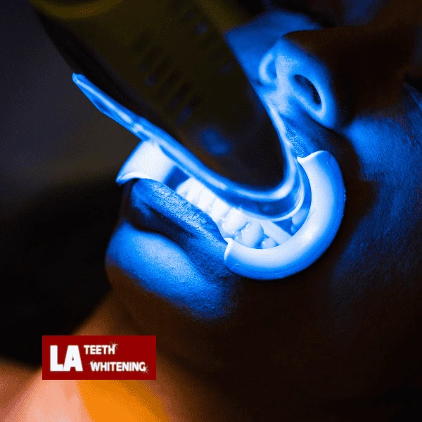 Read our Zoom Teeth Whitening faqs Berkshire. 